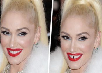 Dişlerin Yüzünüzü Nasıl Değiştirebileceğini Gösteren 15 Fotoğraf